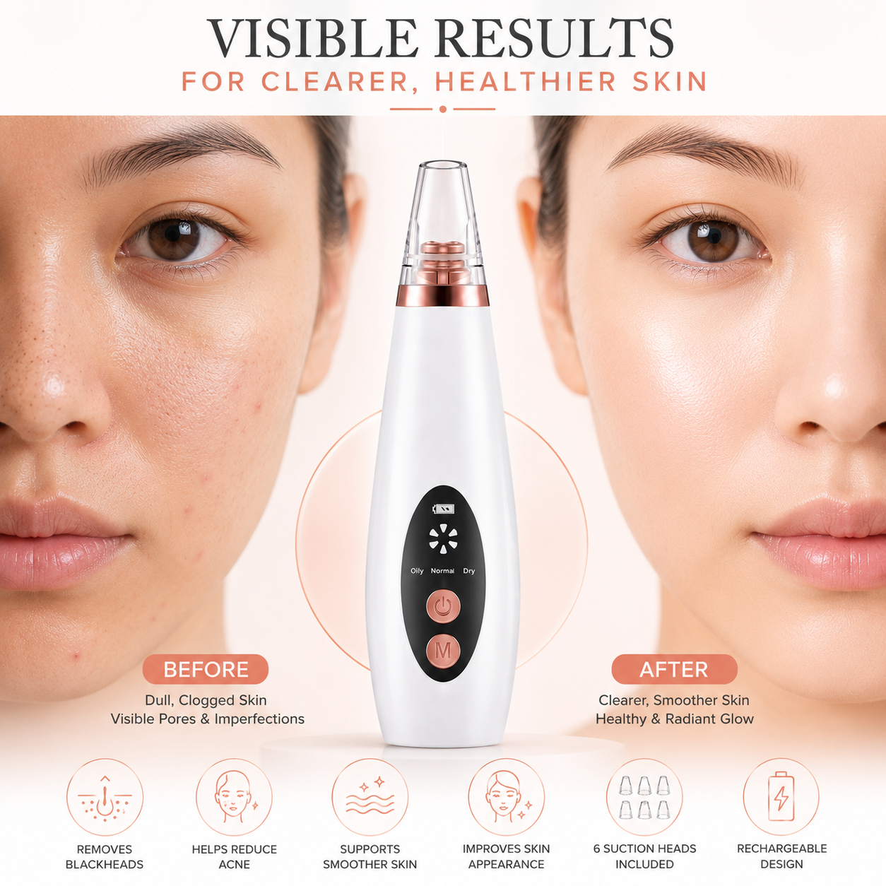 Before and after skincare comparison showing a rechargeable blackhead remover vacuum device between two facial close-ups. Left side displays visible pores, blackheads, and skin texture, while the right side shows smoother and clearer-looking skin. Features highlighted include blackhead removal, acne reduction support, smoother skin appearance, 6 suction heads, and rechargeable design.